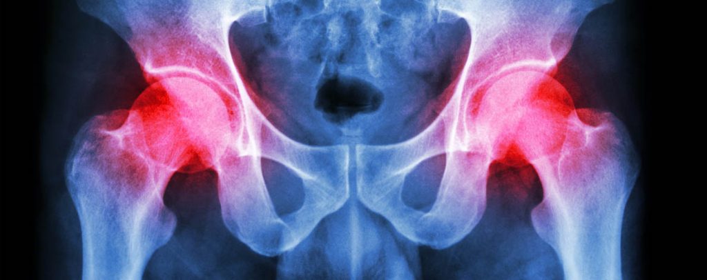 Anterior hip replacement is performed in patients with damage at the hip joint from arthritis